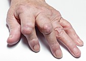 Rheumatoid arthritis of the fingers