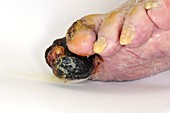 Gangrene of the toes
