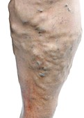 Varicose veins in the leg