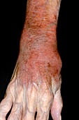 Cellulitis of the wrist