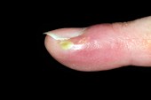 Paronychia infection of the finger