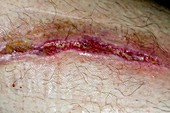 Infected wound on the leg