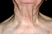 Carotid body tumour in the neck