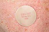 Exelon Alzheimer's drug skin patch