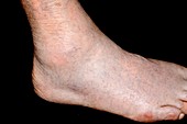 Gout in the ankle