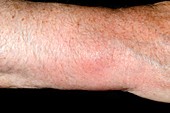 Gout in the wrist