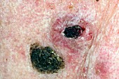 Basal cell skin cancer beside a wart