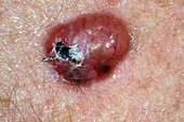 Basal cell skin cancer on the chest