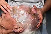 Squamous skin cancer radiotherapy