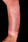 Cellulitis of the arm