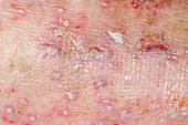 Infected eczema on the skin