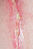 Infected wound on the leg