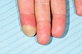 Paronychia infection of the finger