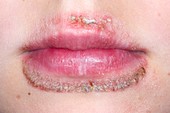 Dermatitis around the mouth