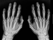 Osteoarthritis in the hands,X-ray