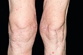Swollen knee due to osteoarthritis