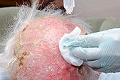 Scalp infection after radiotherapy