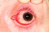 Viral conjunctivitis of the eye
