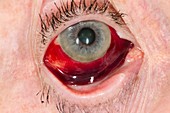 Subconjunctival haemorrhage of the eye