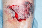 Flap laceration on the shin