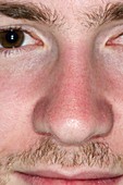 Mild sunburn on the face