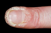 Warts around a fingernail