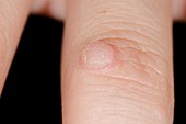 Wart on the finger
