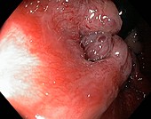 Haemorrhoids,endoscopic view