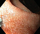 Lining of the duodenum,endoscopic view