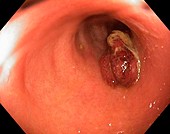 Inflamed intestinal polyp,endoscope view