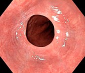 Oesophageal web,endoscopic view