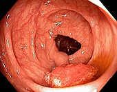 Intestinal polyp,endoscopic view