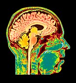 Normal human brain,MRI scan