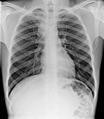 Tuberculosis,chest X-ray