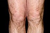 Knee swelling in chondromalacia