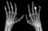 Rheumatoid arthritis,X-ray