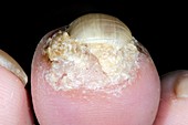 Psoriasis of the toenail