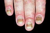 Psoriasis of the fingernails