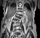 Spinal curvature,CT scan