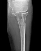 Broken arm bone,X-ray