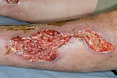 Wound infection after major trauma
