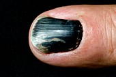 Bruising under the fingernail
