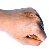 Eczema