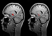 Jealousy,conceptual MRI brain scans