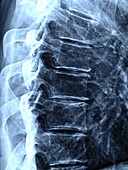 Osteoarthritis of the thoracic spine