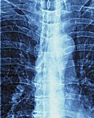 Thoracic spine scoliosis & osteoarthritis