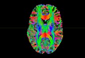 Brain fibres,tract density imaging