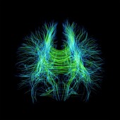 Brain fibres,DTI MRI scan