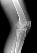 Melorheostosis of the knee,X-ray