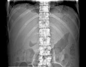 Secondary bone cancer,X-ray